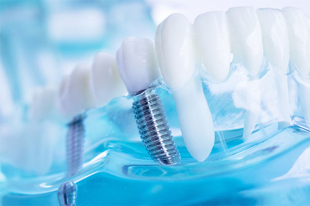 Dental Implants in Deerfield IL