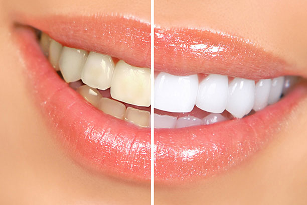 Teeth Whitening in Deerfield IL